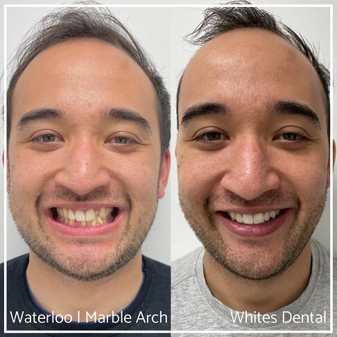 Photo of adult male before and after braces- Adult Braces for crossbite