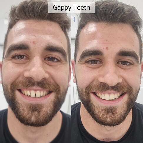 Braces Cost London - middle age man with gaps in teeth