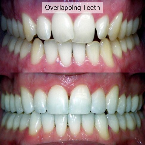 Braces Cost London - overlapping teeth