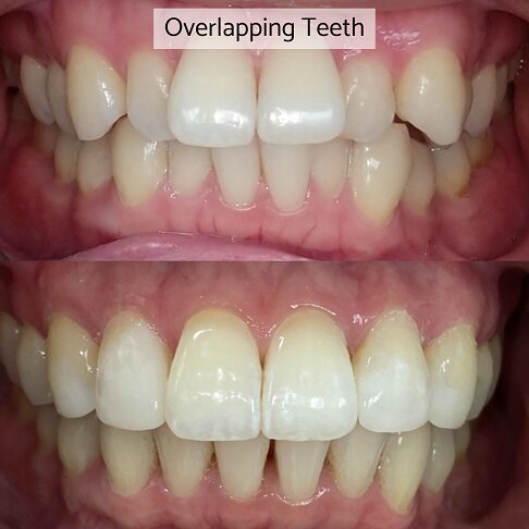 Braces Free Consultation in London - overlapping teeth