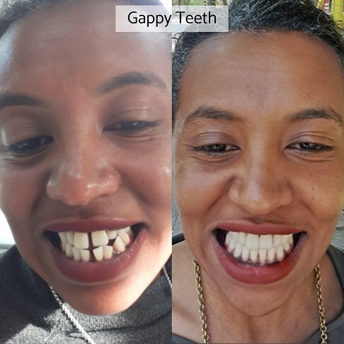 Braces London - Girl with gappy teeth