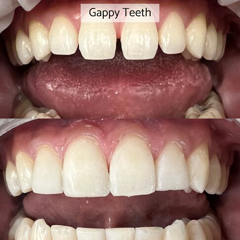 Composite Bonding London - Gap in Front Two Teeth