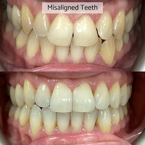 Invisalign London - misaligned teeths