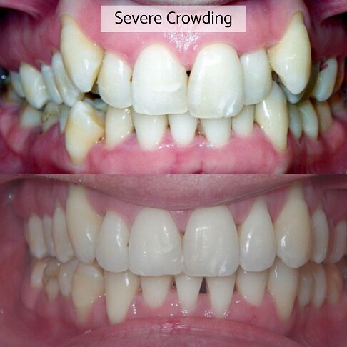 Invisalign London - severe crowding