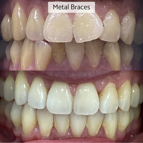 Metal Braces - Over Bite Correction