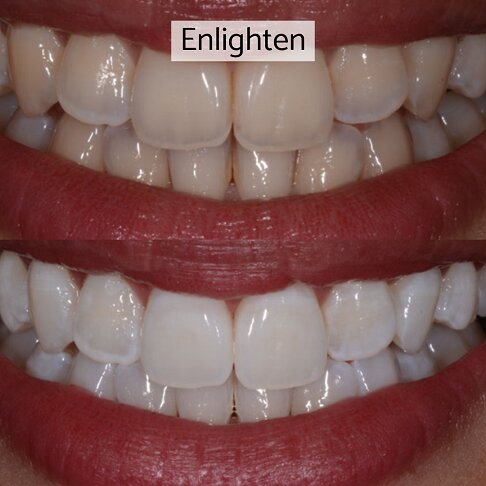 Teeth Whitening Cost London - Enlighten Before And After 1