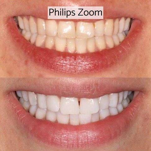 Teeth Whitening Cost London - Philips Zoom Before And After 1