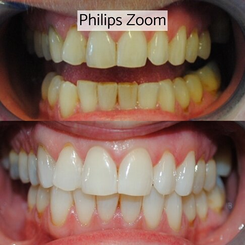 Teeth Whitening Cost London - Philips Zoom Before And After 2