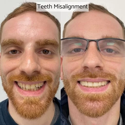 Dental Veneers London - Before After - Teeth Misalignment For Crooked Teeth