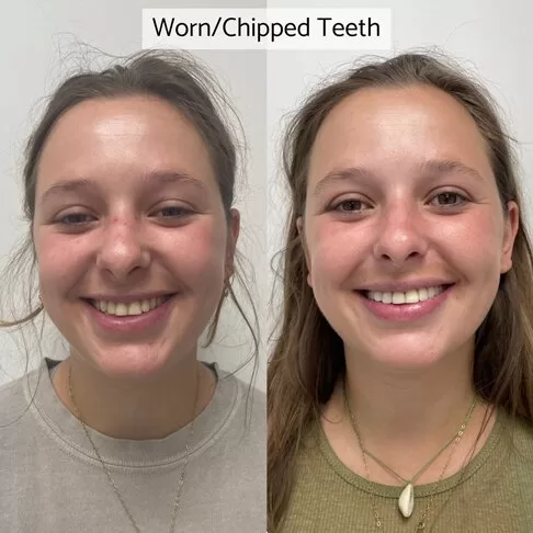 Dental Veneers London - Before After - Worn Out Chipped Teeth