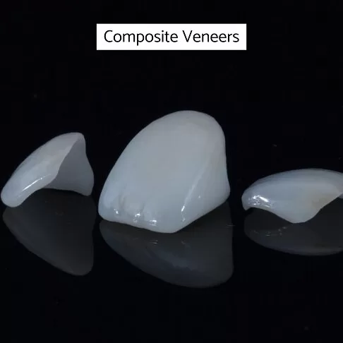 Dental Veneers London - Composite Veneers