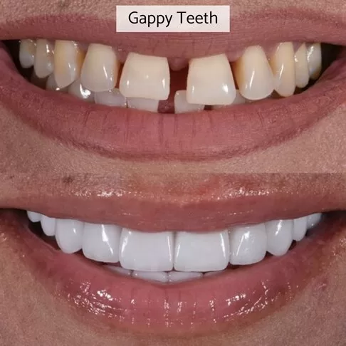 Dental Veneers London - fixing gaps in teeth