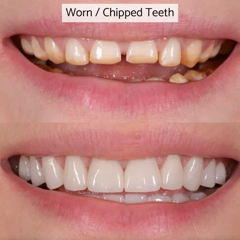 Dental Veneers London - fixing worn out or chipped teeth