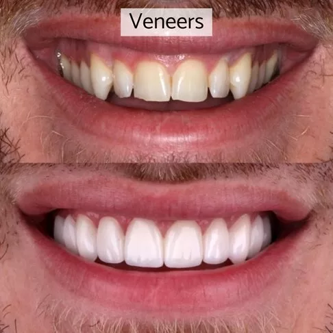 Dental Veneers Vs Composite Bonding - Veneers Before After Photo