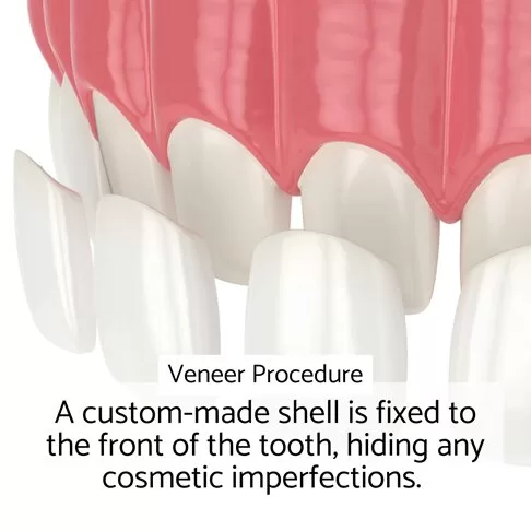 Dental Veneers Vs Composite Bonding - Veneers Procedure