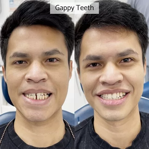 Dental Veneers Before And After - Gappy Smile Corrected With Porcelain Veneers