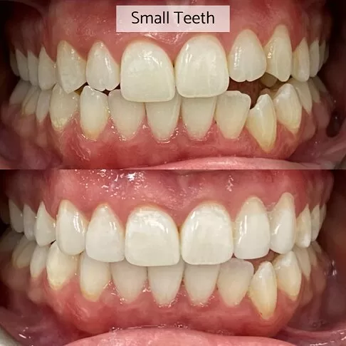 Dental Veneers Before And After - Small Teeth