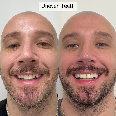 Dental Veneers Before And After - Uneven Sized Teeth