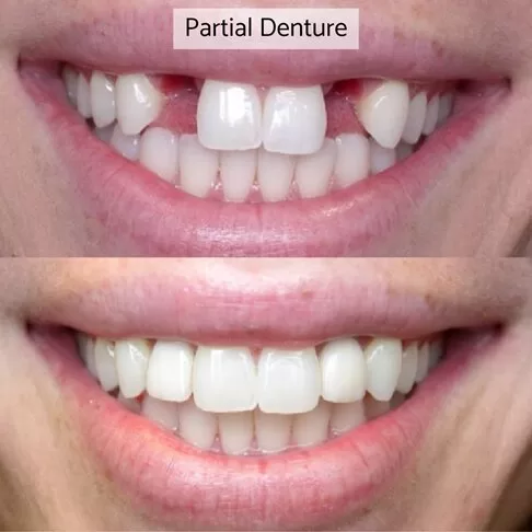 photo of front teeth dentures - before and after