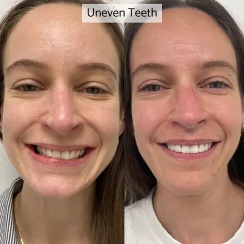 Porcelain Veneers In London - Before After - Uneven teeth