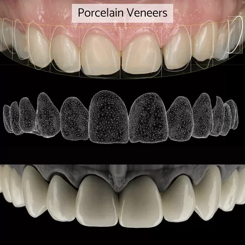 Porcelain Veneers In London - Design Your Perfect Smile