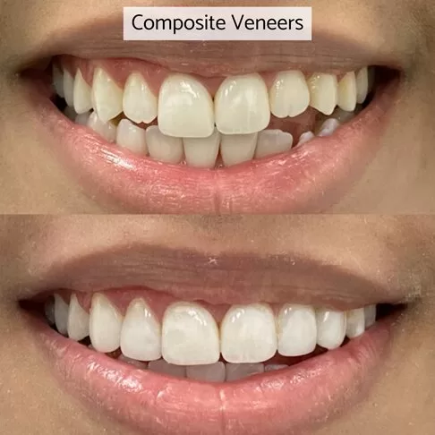 Porcelain Veneers Vs Composite Veneers - Composite Veneers Before After Photo