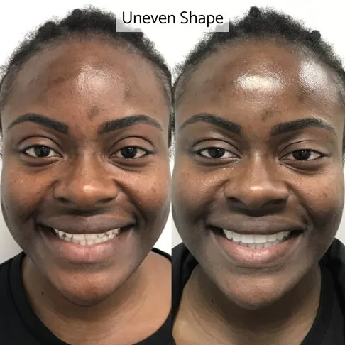 Veneers Cost London - Before And After - Unevenly shaped teeth