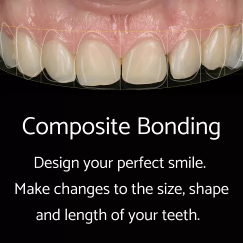 Whites Dental London - Fees - Composite Bonding