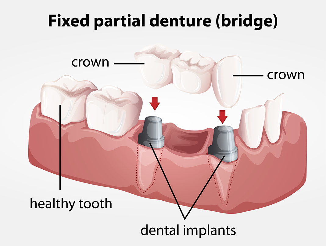 labelled diagram showing the implants, crowns and denture bridge