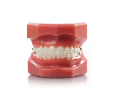 Ceramic Braces Cost in London