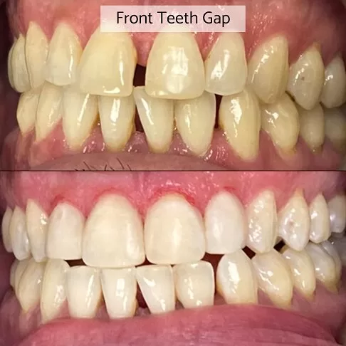 Cosmetic Dentist London - Before After Front Tooth Gap