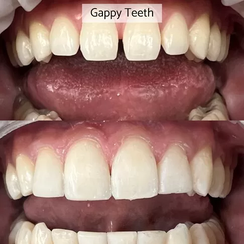 Cosmetic Dentist London - Before After Gap in Front Two Teeth