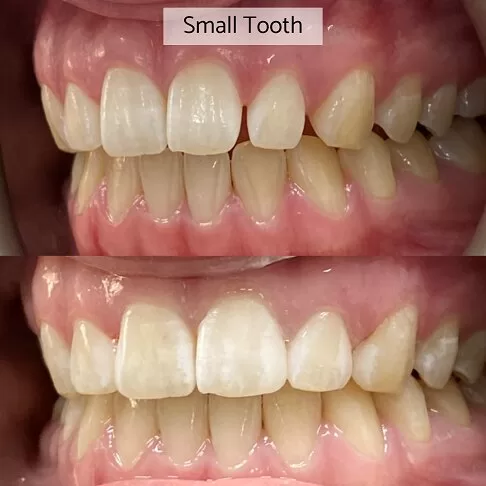 Cosmetic Dentist London - Before After Small Tooth Size