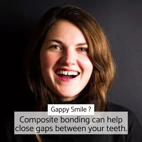 Cosmetic Dentist London - Composite Bonding For A Gappy Smile