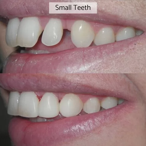 Cosmetic Dentist London - Reshape Teeth With Bonding