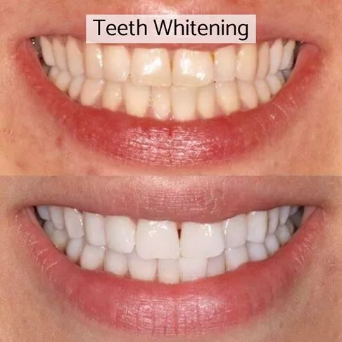 Cosmetic Dentist London - Teeth Whitening