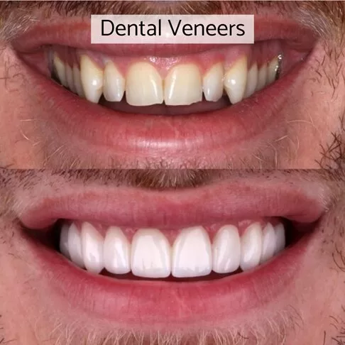 Cosmetic Dentist London - Veneers