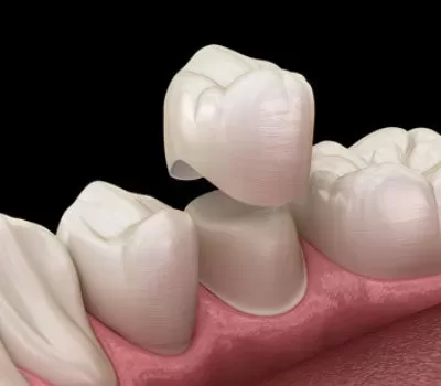 Dental crown being placed on a tooth illustration, showcasing Emergency Dentist Paddington’s restorative solutions