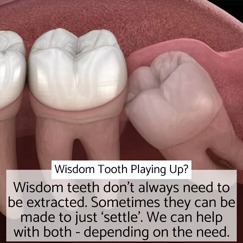 Wisdom teeth illustration, emphasizing Emergency Dentist in Paddington’s care options for managing problematic wisdom teeth